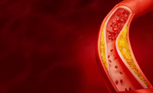 Read more about the article ระดับคอเลสเตอรอลชนิดเลว (LDL) ต่ำ อาจเพิ่มความเสี่ยงโรคเบาหวาน (ทั้งที่ใช้และไม่ใช้ยากลุ่มสแตติน)