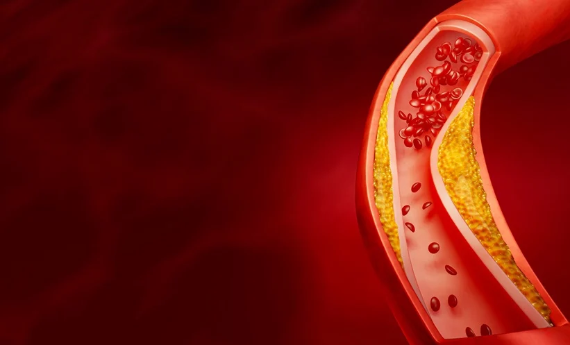 Read more about the article ระดับคอเลสเตอรอลชนิดเลว (LDL) ต่ำ อาจเพิ่มความเสี่ยงโรคเบาหวาน (ทั้งที่ใช้และไม่ใช้ยากลุ่มสแตติน)